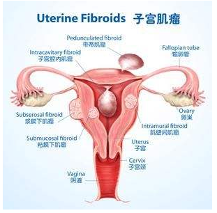 女性要如何预防子宫肌瘤